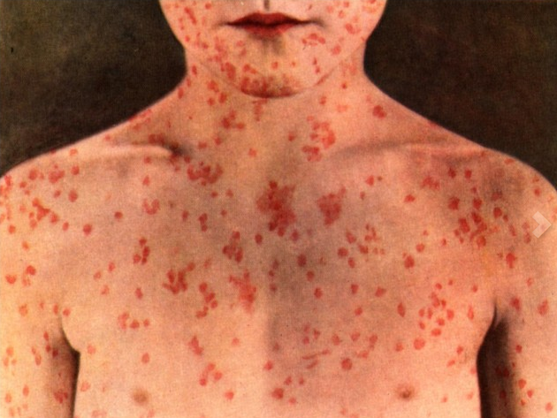 Measles is one of the most contagious infectious diseases. Its rash consists of small red spots