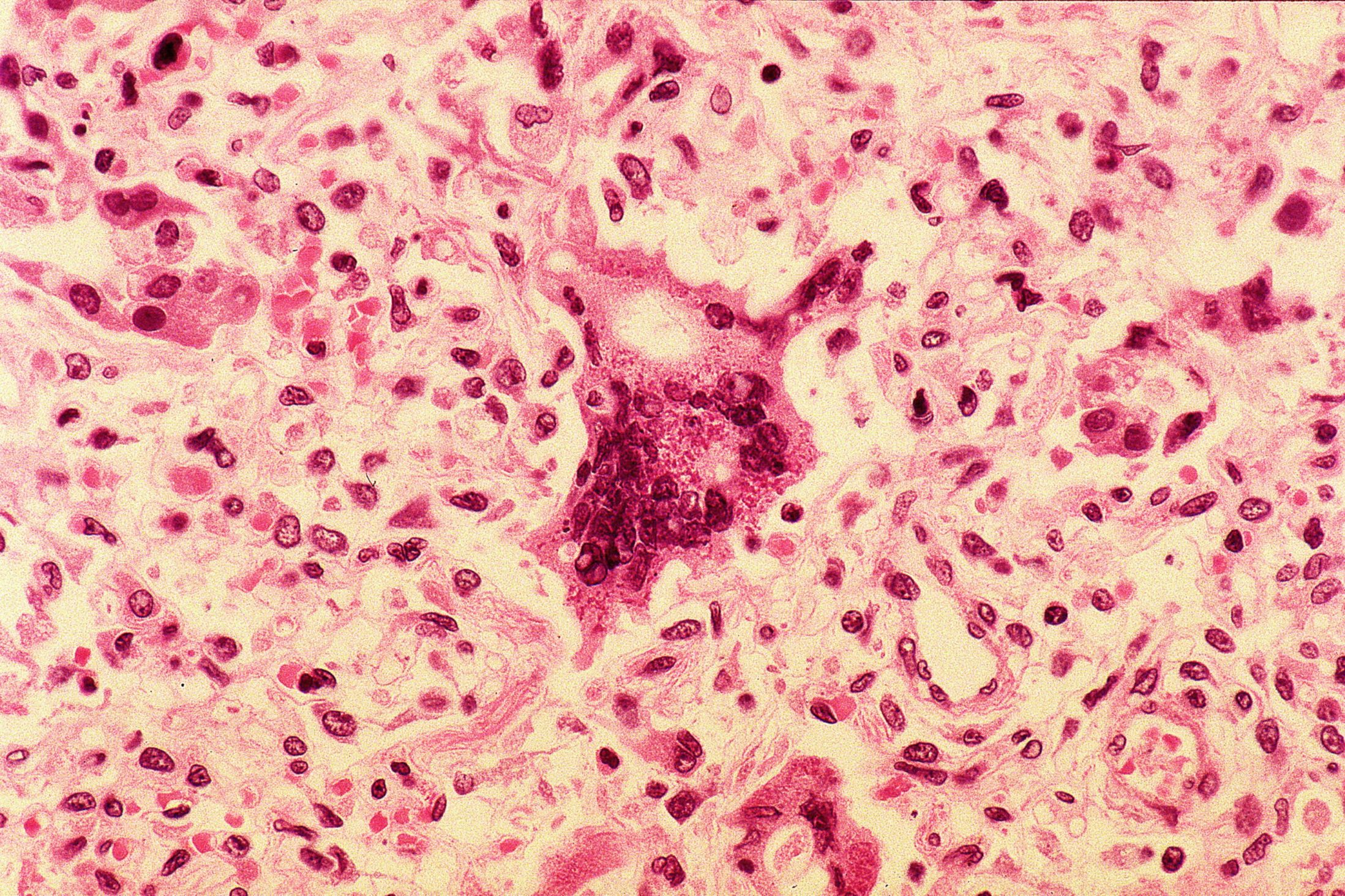 The measles virus