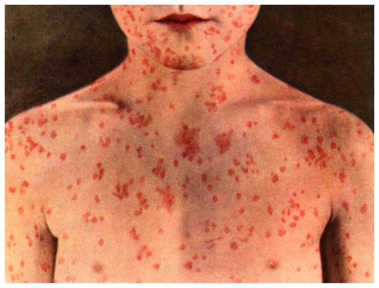 Public health officer: Olympic Peninsula 'dodges a bullet' on measles outbreak in state